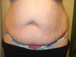 tummy tuck for stretch marks