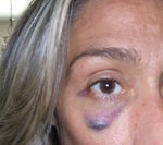 botox hematoma