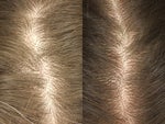 Hair Loss Treatment before and after photos
