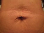 Six weeks ago I had a mini-tummy tuck and hernia repair