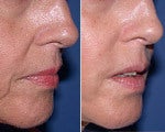 Injectable Fillers before and after photos