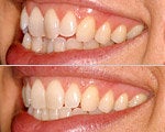 Invisalign before & after photos