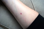 Final Results: It Works Paste for Mole Removal