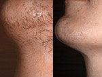 Laser Hair Removal before and after photos