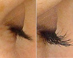 Latisse before & after photos
