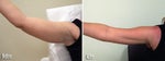 Mesotherapy before & after photos