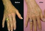 Younger Hands with Restylane and more