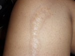 hot wax burn scar