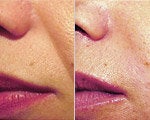 Sculptra before and after photos