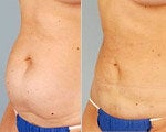 Smart Lipo before and after photos