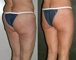 Thigh Lift before and after photos