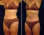 Tummy tuck before & after photos