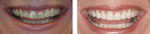 Porcelain Veneers before and after photos