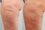 Cellulaze before and after photos