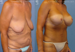 Weight Loss before and after photos