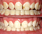 Teeth Whitening before and after photos