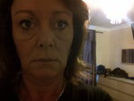 does botox cause under eye bags