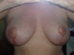 low breasts after surgery