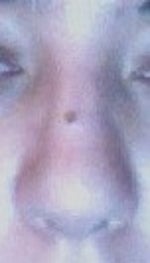 Please help! Looking for Rhino Specialist in DC/MD/VA/NY/NJ or anywhere in between to help with my ethnic nose!
