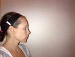 Revision rhinoplasty for severe over rotation...can this be fixed? How difficult is the surgery, aprox cost? 