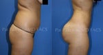 Brazilian Butt Lifts are popular, but how do you get it done safely?