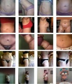 RealSelf is allows for social sharing of plastic surgery photos, before and after