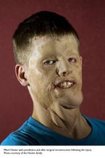 Mitch Hunter face transplant