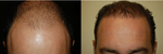 NeoGraft: Meet the NKOTB of Hair Transplants