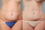 CoolSculpting result before and after