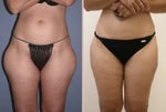 Liposuction before and after does fat grow back?