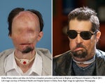 Dallas Wiens full facial transplant