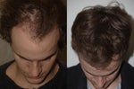 before and after hair transplant