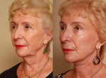 Facelift before and after over 65
