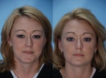 Botox as wrinkle prevention