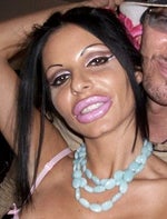 Priscilla Caputo, too much lip collagen