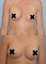 Collapsed Saline implant