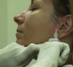 Jill Zarin gets liquid facelift, c/o Bravo TV Network