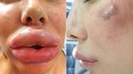 Risks and side effects of home Botox kits