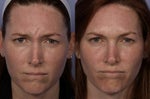 Botox before and after by Dr. Grant Stevens