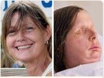Charla Nash before and after face transplant