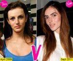 ali lohan plastic surgery