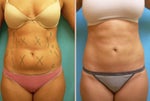 liposuction heart benefits