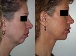 chin implant before and after