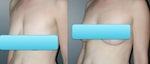 teen breast lift