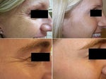 Botox vs. Dysport