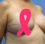 nipple reconstruction options