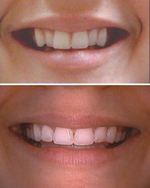 Invisalign before and after