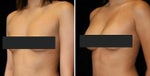 natural looking breast implants