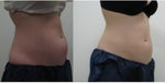 coolsculpting by zeltiq before and after