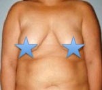 tuberous breast surgery